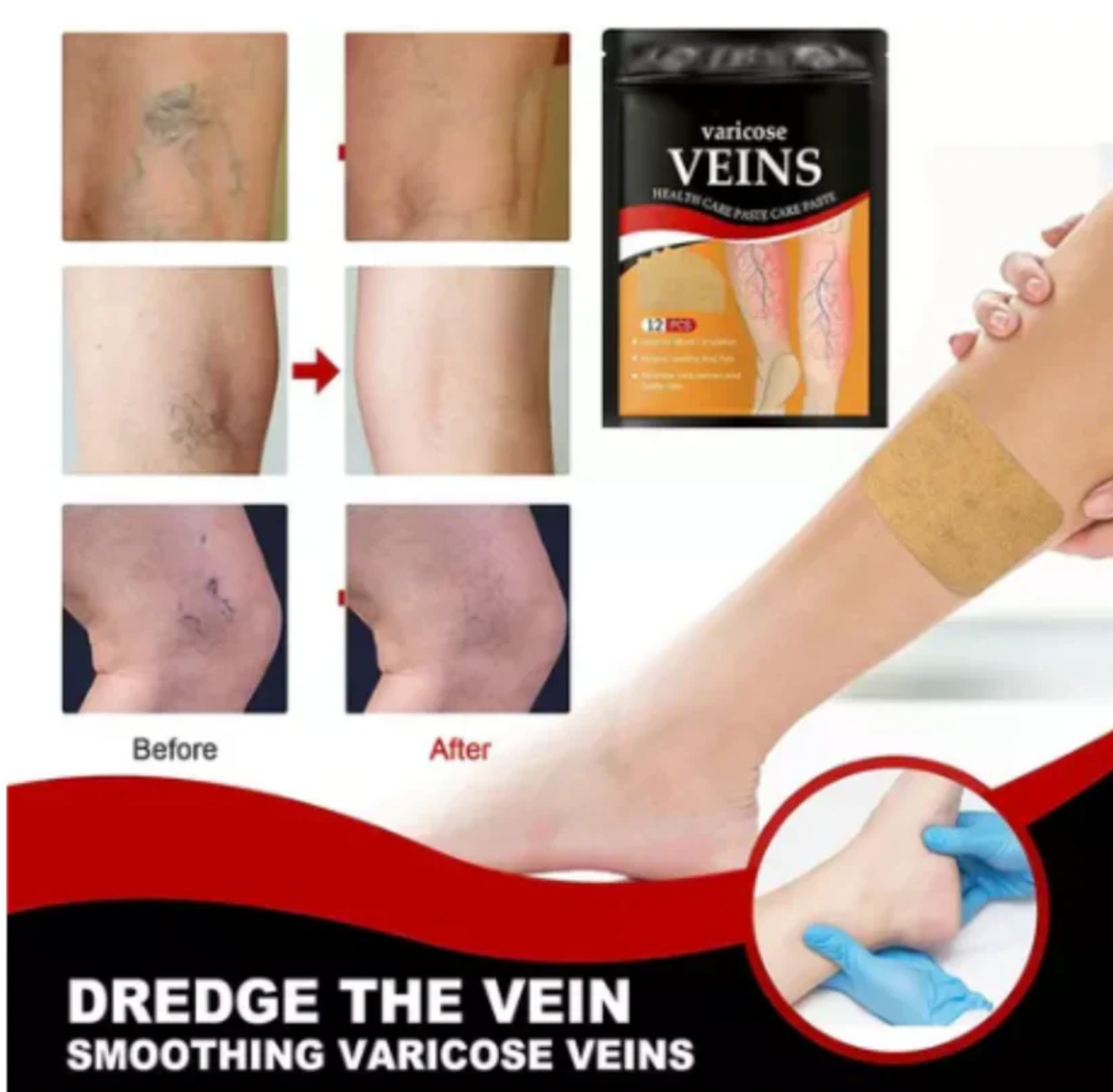 OFERTA 3x1 Nuevo Quita Varices Parches+ENVIO GRATIS