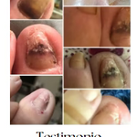 JoyPretty 2X1 ¡Elimina los hongos de tus uñas al instante! +ENVÍO GRATIS