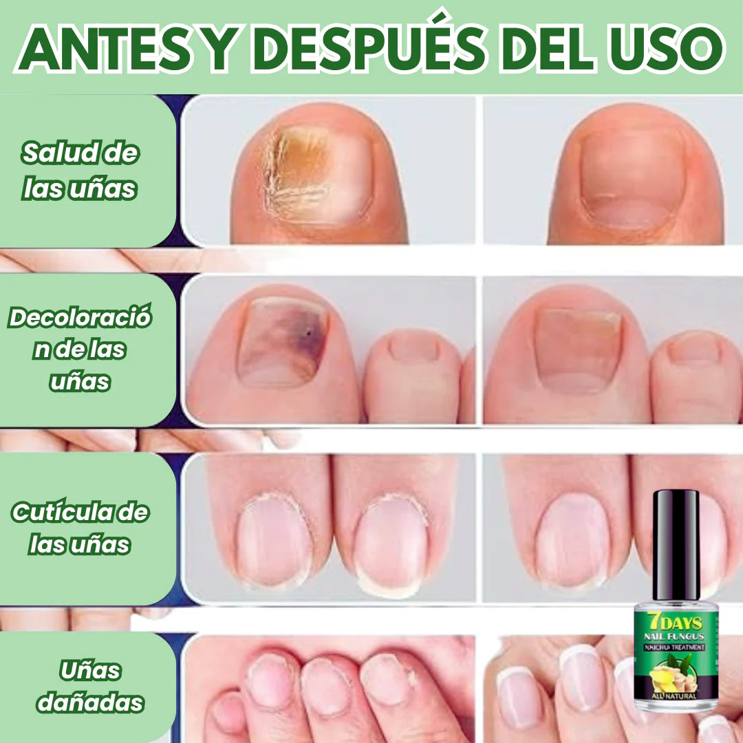 JoyPretty 2X1 ¡Elimina los hongos de tus uñas al instante! +ENVÍO GRATIS