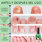 JoyPretty 2X1 ¡Elimina los hongos de tus uñas al instante! +ENVÍO GRATIS