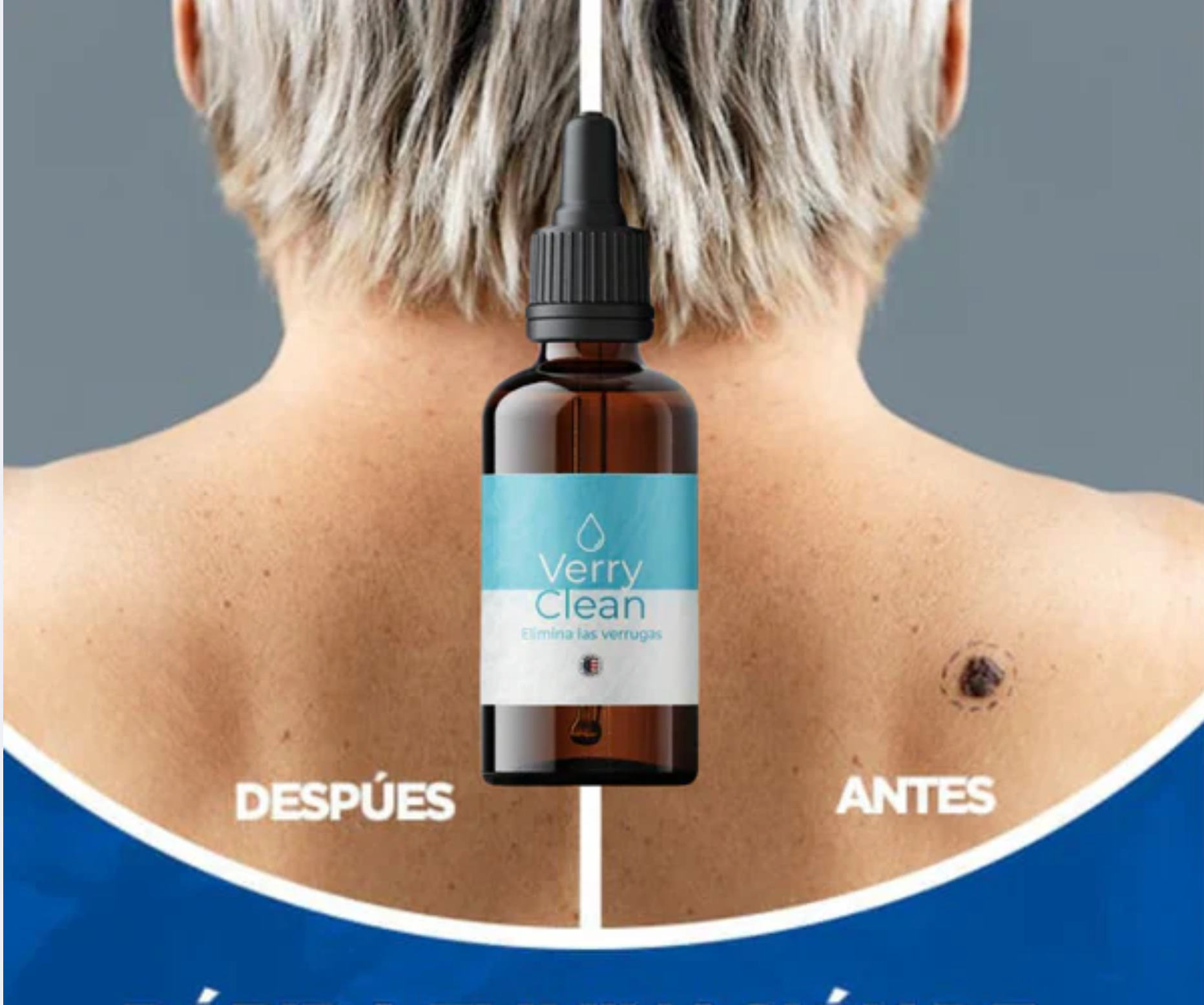 OFERTA 2x1 Quita Verrugas y Manchas VERRYCLEAN+ENVIO GRATIS