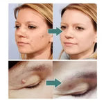 OFERTA 2x1 Quita Verrugas y Manchas FORMUCLEAR+ENVIO GRATIS