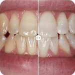 OFERTA 2X1+ 🦷✨ BLANQUEADOR DENTAL🦷✨+ENVÍO GRATIS